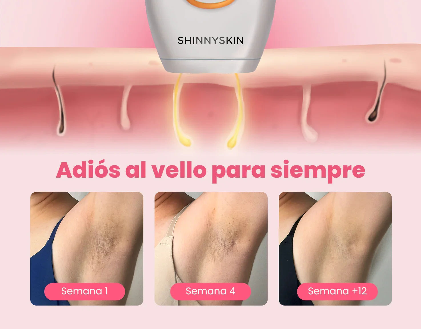 Depiladora Permanente IPL clásica